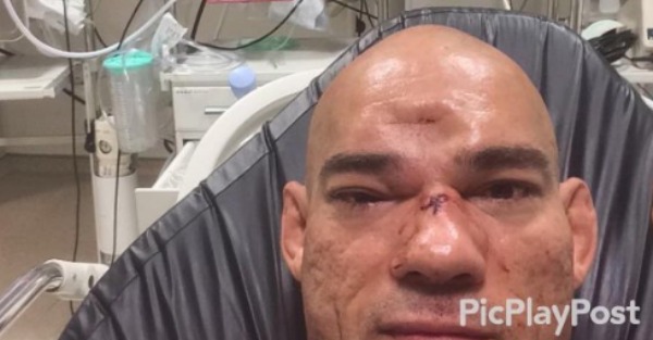 Fighter had surgery to fix his broken face, now looks like Frankenstein with this horrific scar