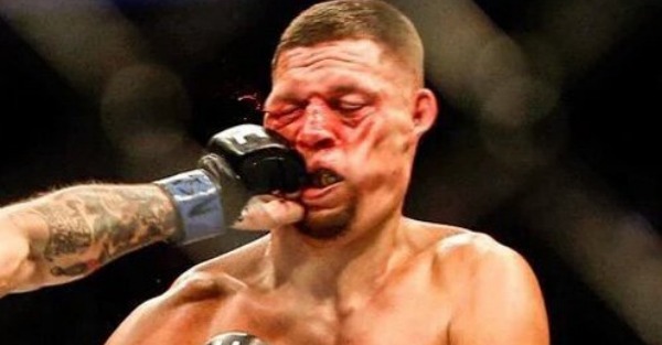 Nate Diaz thinks he won the fight, but his face looks like it had been though a meat grinder